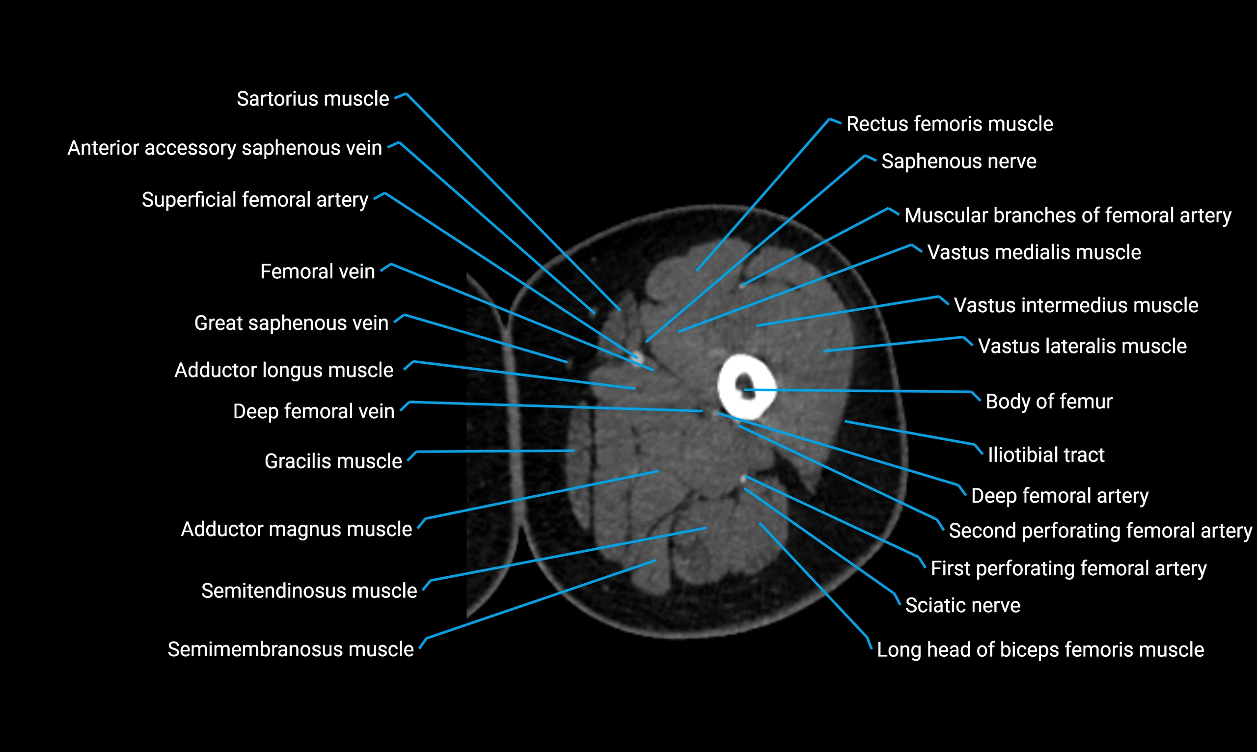 CT lower limb axial cross sectional anatomy labelled image 40 (2).webp